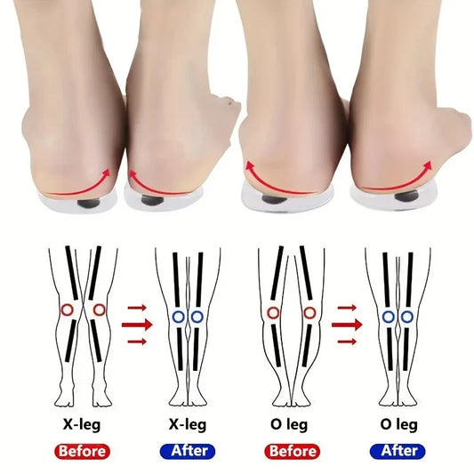 AliExpress Other Valgus 1Pair Orthopedic Insoles for Feet & O/X Leg Types